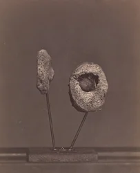 Entferntes Kniegelenk. Eine runde Musketenkugel im inneren Kondylus des rechten Oberschenkelknochens [Gardin...]